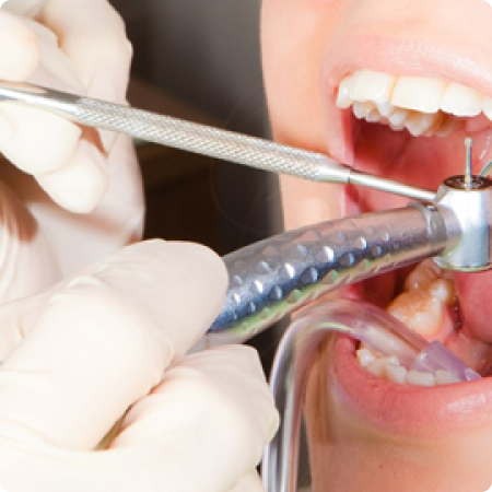 Stomatološke usluge Bolesti zuba i endodoncija